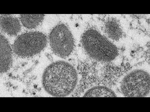 U.S. releasing Monkeypox vaccine