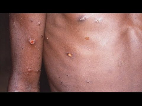 CDC confirms first case of monkeypox in Georgia