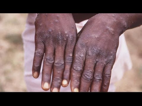 CDC expanding monkeypox testing in the US