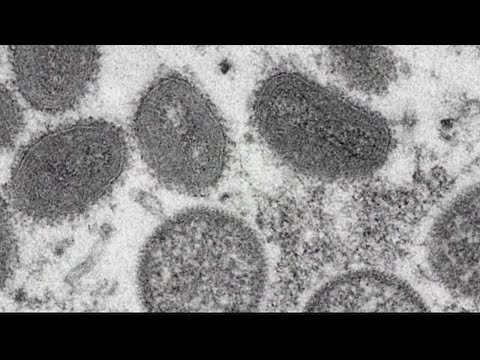 CDC: 2 children now have monkeypox