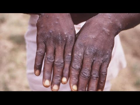Officials named to head White House monkeypox response