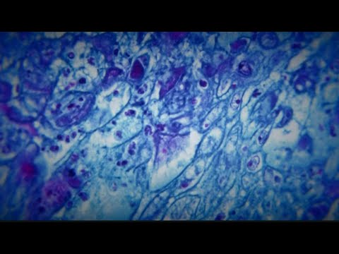 Monkeypox cases declining in Georgia