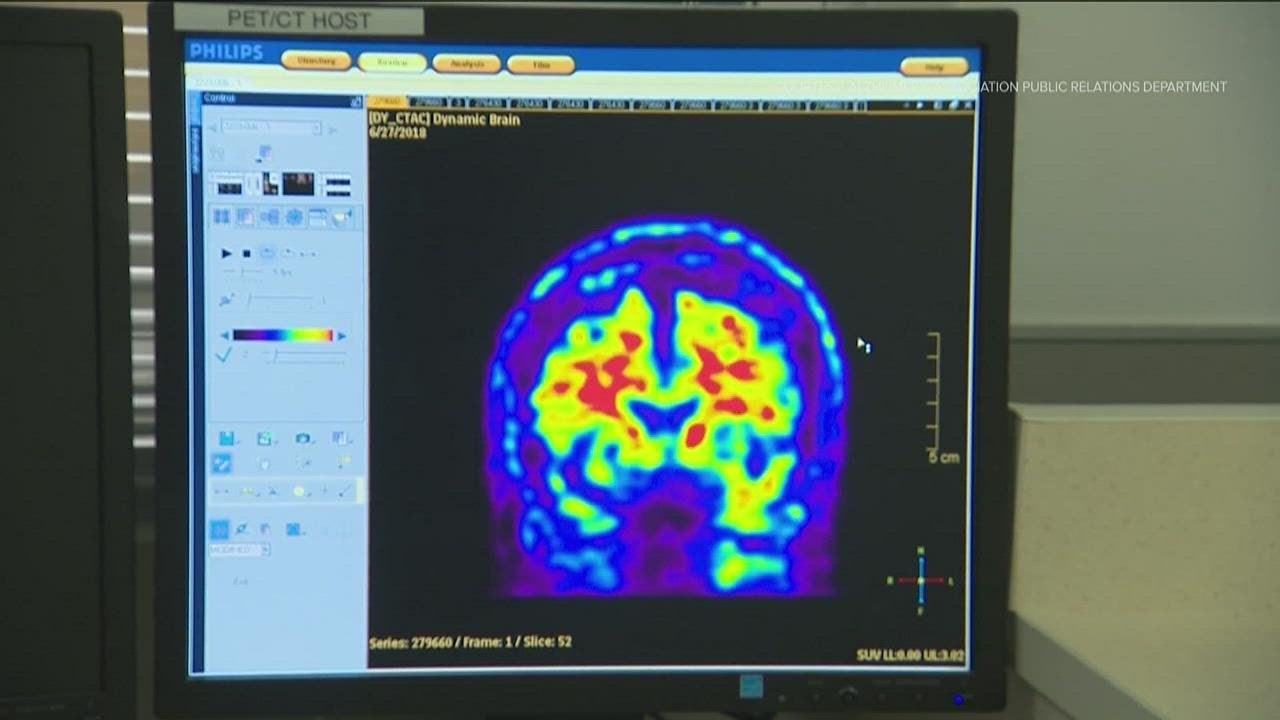 Alzheimer's clinical trial drug yields negative result