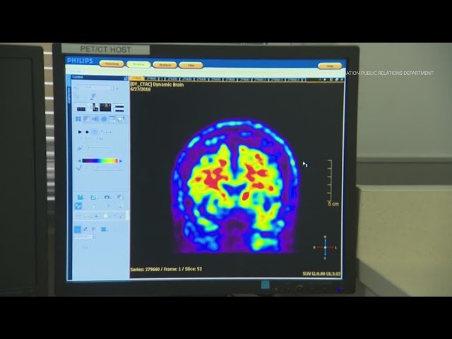 New drug could help reduce symptoms of Alzheimer's