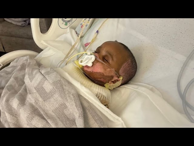 Georgia baby Amahd Bubby recovery after candle explosion accident