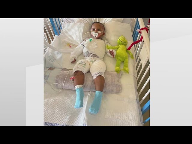 Georgia baby burned in freak accident awake, recognizes parents