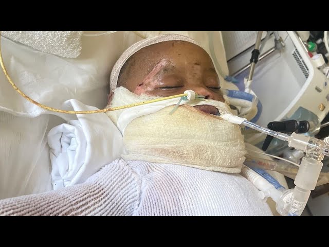 Georgia baby severely burned in freak accident, family struggling through recovery