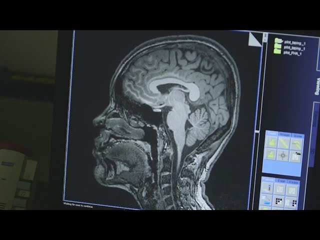 FDA decision on Alzheimer's drug expected this week