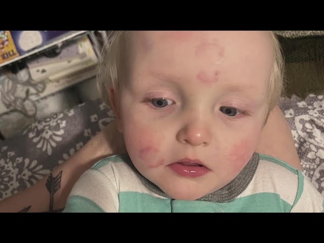 Daycare under investigation after mom picked up son covered in bites